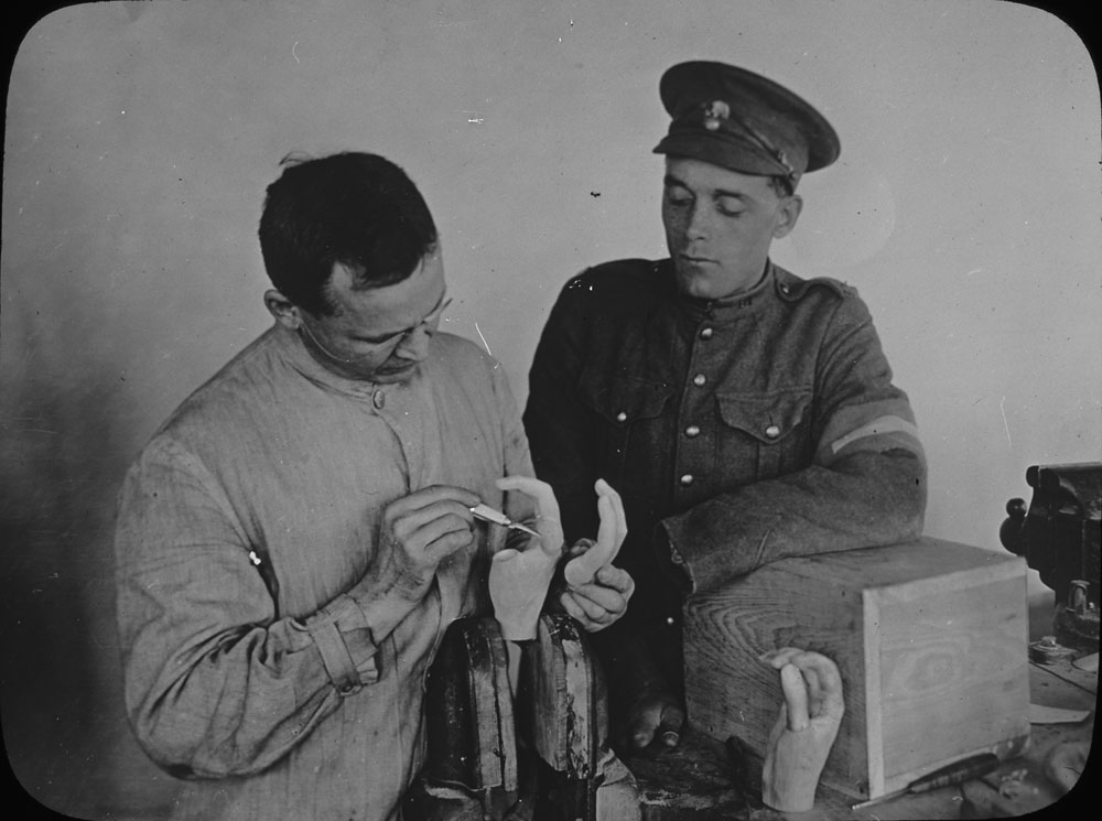 Amputations Prosthetic Limbs In The First World War Through